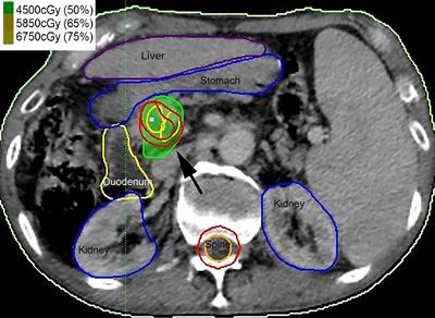 Hypofractionated Radiotherapy for Palliation of Main Portal Vein Tumor Thrombosis